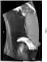Fig. 03 - Method and system for automatically analyzing placenta insufficiency in a curved topographical ultrasound image slice