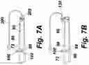 Fig. 06 - Fish hook barb disabler