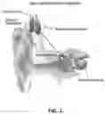 Fig. 02 - SYSTEMS AND METHODS FOR DETECTING THE PRESENCE OF ELECTRICALLY EVOKED COMPOUND ACTION POTENTIALS (eCAPS), ESTIMATING SURVIVAL OF AUDITORY NERVE FIBERS, AND DETERMINING EFFECTS OF ADVANCED AGE ON THE ELECTRODE-NEURON INTERFACE IN COCHLEAR IMPLANT USERS