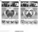Fig. 02 - USE OF NEUROMELANIN-SENSITIVE MRI AS A BIOMARKER OF DOPAMINE FUNCTION