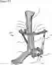 Fig. 16 - External fixation for the correction of bone deformity and trauma