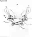 Fig. 17 - External fixation for the correction of bone deformity and trauma