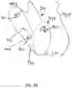 Fig. 06 - Method and apparatus for securing a patient's limb