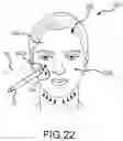 Fig. 22 - Therapeutic wand system, kit, and method