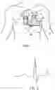 Fig. 02 - METHOD AND SYSTEM FOR COMMUNICATION BETWEEN A PLURALITY OF IMPLANTABLE MEDICAL DEVICES