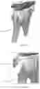 Fig. 02 - BONE FIXATION SYSTEM AND ELEMENTS THEREOF