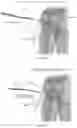 Fig. 07 - BONE FIXATION SYSTEM AND ELEMENTS THEREOF