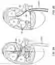 Fig. 03 - RENAL NERVE DENERVATION VIA THE RENAL PELVIS