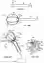 Fig. 11 - RENAL NERVE DENERVATION VIA THE RENAL PELVIS