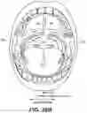 Fig. 28 - METHOD AND APPARATUS FOR TREATING SLEEP APNEA