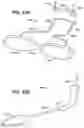 Fig. 35 - METHOD AND APPARATUS FOR TREATING SLEEP APNEA