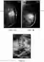 Fig. 02 - Fiducial marker for oncological and other procedures
