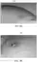 Fig. 04 - Fiducial marker for oncological and other procedures