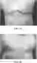 Fig. 03 - TOPICAL COMPOSITIONS FOR TREATING OR PREVENTING SCARS AND METHODS FOR THEIR USE