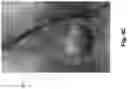 Fig. 07 - VENOUS COMPRESSION SITE IDENTIFICATION AND STENT DEPLOYMENT GUIDANCE, AND ASSOCIATED DEVICES, SYSTEMS, AND METHODS