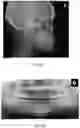 Fig. 07 - SURGICAL METHOD FOR CHANGING A NASOLABIAL ANGLE