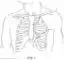 Fig. 02 - FEEDTHROUGH ASSEMBLY AND IMPLANTABLE MEDICAL DEVICE INCLUDING SAME