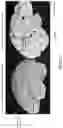 Fig. 02 - RESECTIVE EPILEPSY SURGERY BRAIN SIMULATOR