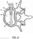 Fig. 06 - Bone Fixation System for Spinal Stabilization
