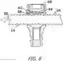 Fig. 08 - Bone Fixation System for Spinal Stabilization