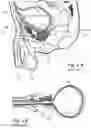 Fig. 02 - Devices, systems and methods for treating benign prostatic hyperplasia and other conditions