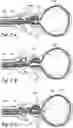 Fig. 03 - Devices, systems and methods for treating benign prostatic hyperplasia and other conditions