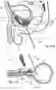 Fig. 04 - Devices, systems and methods for treating benign prostatic hyperplasia and other conditions