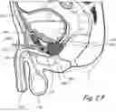 Fig. 05 - Devices, systems and methods for treating benign prostatic hyperplasia and other conditions