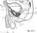 Fig. 06 - Devices, systems and methods for treating benign prostatic hyperplasia and other conditions