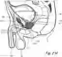 Fig. 07 - Devices, systems and methods for treating benign prostatic hyperplasia and other conditions