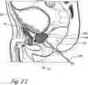 Fig. 08 - Devices, systems and methods for treating benign prostatic hyperplasia and other conditions