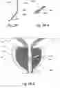 Fig. 40 - Devices, systems and methods for treating benign prostatic hyperplasia and other conditions