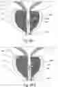 Fig. 41 - Devices, systems and methods for treating benign prostatic hyperplasia and other conditions