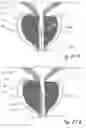 Fig. 52 - Devices, systems and methods for treating benign prostatic hyperplasia and other conditions