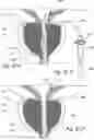 Fig. 55 - Devices, systems and methods for treating benign prostatic hyperplasia and other conditions