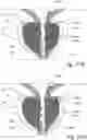 Fig. 56 - Devices, systems and methods for treating benign prostatic hyperplasia and other conditions