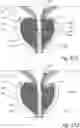 Fig. 57 - Devices, systems and methods for treating benign prostatic hyperplasia and other conditions