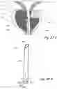 Fig. 58 - Devices, systems and methods for treating benign prostatic hyperplasia and other conditions