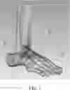 Fig. 02 - Patient-specific template for total ankle replacement