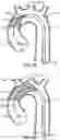 Fig. 07 - EMBOLIC PROTECTION METHODS