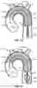 Fig. 09 - EMBOLIC PROTECTION METHODS