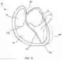 Fig. 06 - Tissue anchor deployment