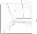 Fig. 31 - Tissue anchor deployment