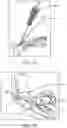 Fig. 14 - PUSH-IN SUTURE ANCHOR SYSTEM