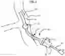 Fig. 02 - EXPANDABLE INTRODUCER SHEATH