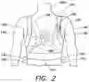 Fig. 03 - Wearable therapeutic device