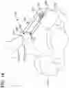 Fig. 16 - LAMINOPLASTY IMPLANT SYSTEMS AND METHODS