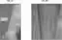 Fig. 09 - TREATMENT OF PRURIGO NODULARIS