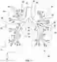 Fig. 02 - METHODS AND DEVICES FOR THE TREATMENT OF PULMONARY DISORDERS WITH A BRAIDED IMPLANTABLE FLOW CONTROL DEVICE
