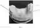 Fig. 02 - Access guide and drill kit to be used with same for endodontic access cavity preparation and method of use